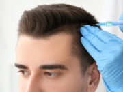 Saç PRP Uygulaması