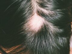 Saçkıran (Alopesi Areata) nedir?