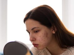 Akne Nedir? Çeşitleri Nelerdir? Beslenmeyle ilişkisi