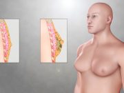 Jinekomasti Nedir? Erkeklerde Meme Büyümesi Neden Olur ve Nasıl Tedavi Edilir?