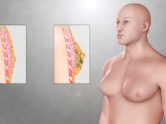 Jinekomasti Nedir? Erkeklerde Meme Büyümesi Neden Olur ve Nasıl Tedavi Edilir?