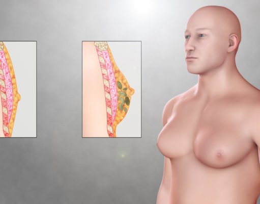 Jinekomasti Nedir? Erkeklerde Meme Büyümesi Neden Olur ve Nasıl Tedavi Edilir?
