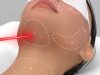 Endolift estetiği