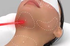 Endolift estetiği
