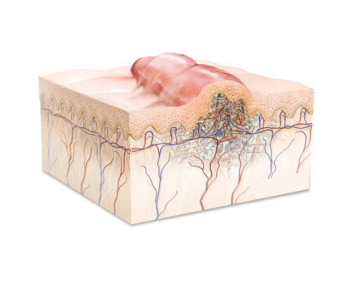 Keloid