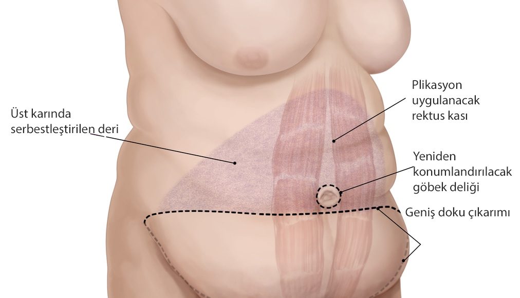 abdominoplasti karın germe ameliyatı