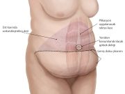 Karın Germe Ameliyatı (Abdominoplasti)