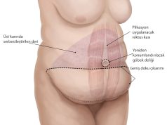 Karın Germe Ameliyatı (Abdominoplasti)