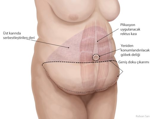 Karın Germe Ameliyatı (Abdominoplasti)